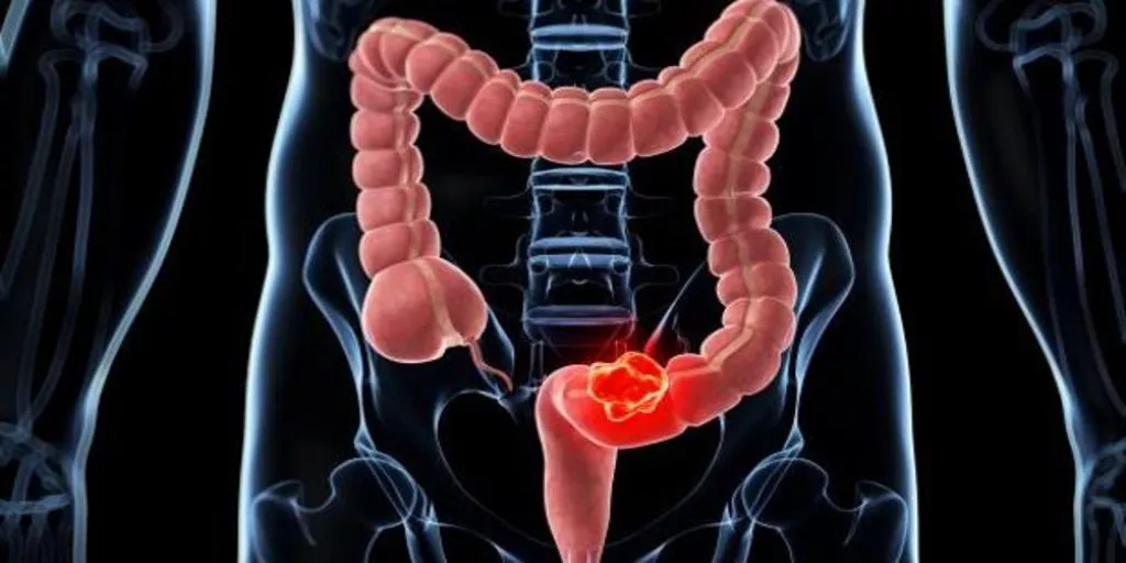 cancer-colon-sintomas-kMaG--1024x512@abc