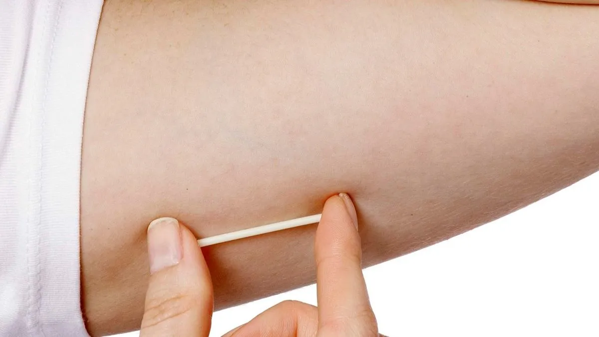 el-implante-subdermico-es-el-mas-pedido-adolescentes