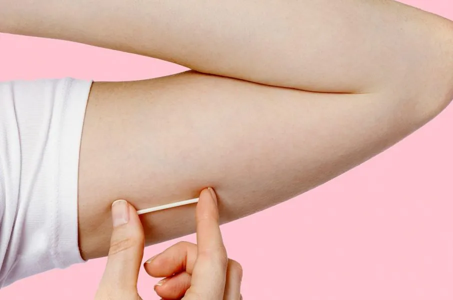 89142-colocaran-implantes-subdermicos-anticonceptivos-a-mujeres-de-hasta-19-anios