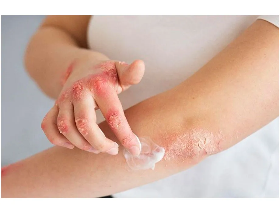 Psoriasis: New Therapy for Skin Health - News Directory 3