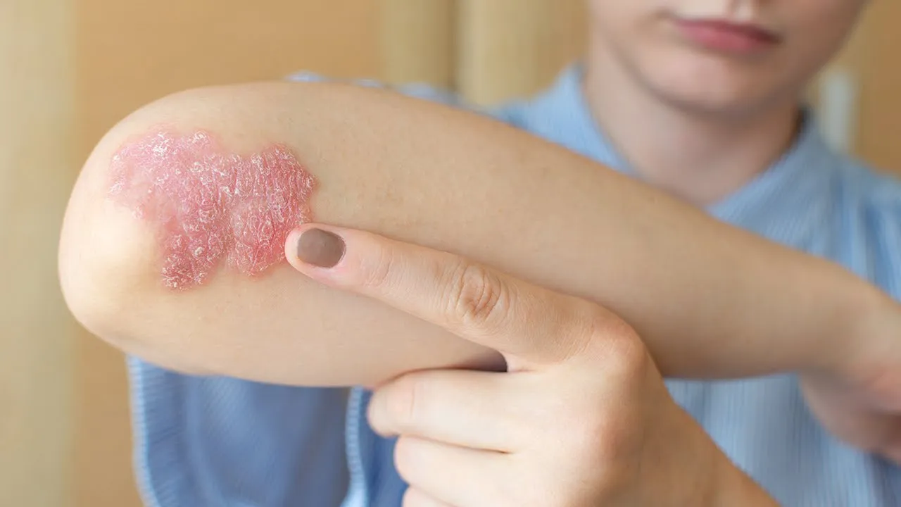 5-Psoriasis-y-diabetes