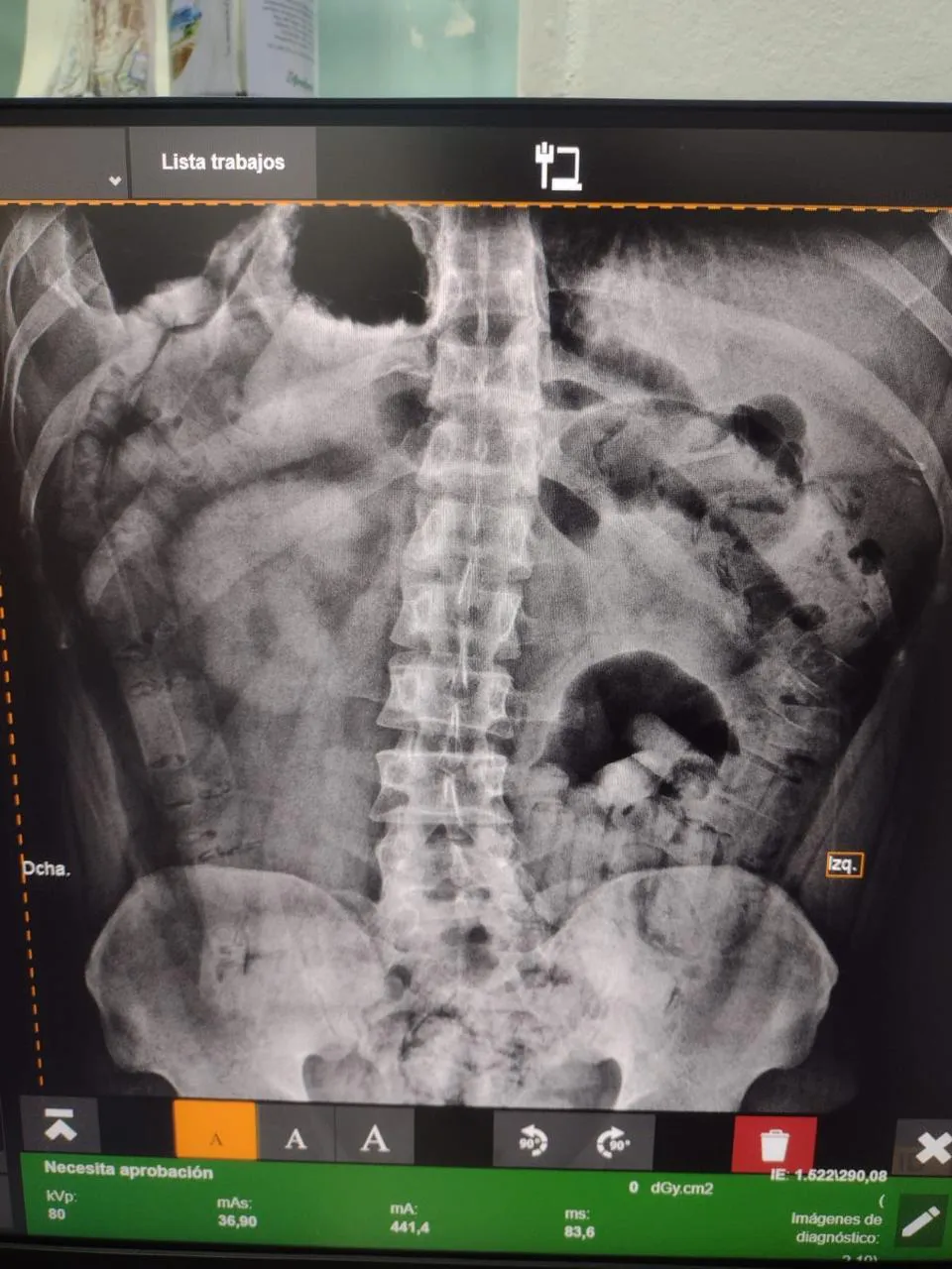 206 cápsulas cocaína Tucumán 4