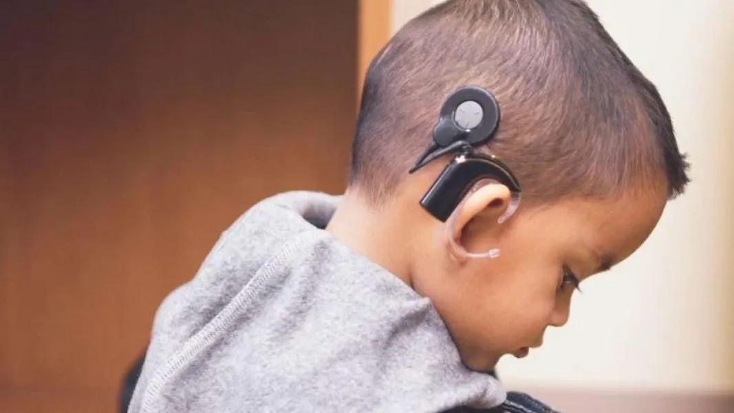 94295-el-implante-coclear-es-una-alternativa-de-solucion-para-pacientes-con-hipoacusia-profunda