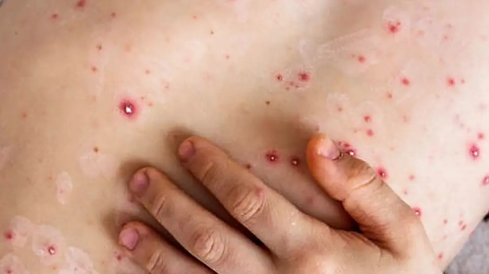lesiones-en-la-piel-provocada-por-la-mpox-o-viruela-del-mono-gsc1