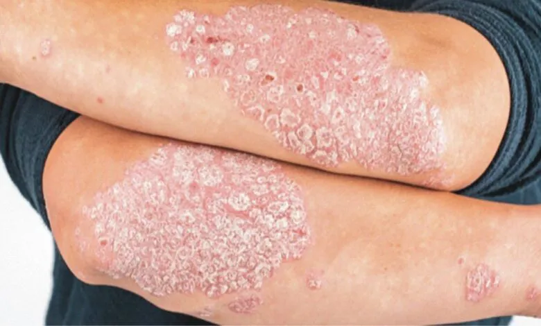 67878-realizaran-una-jornada-de-deteccion-de-psoriasis-en-el-san-bernardo-780x470