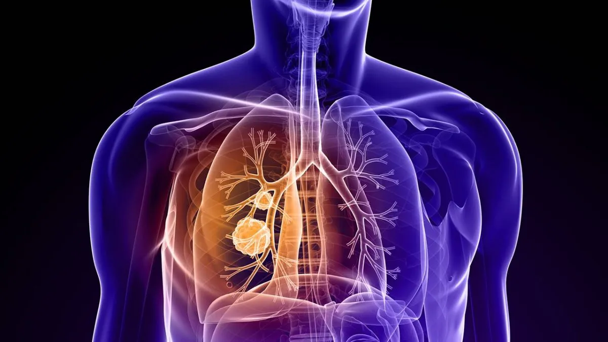 cancer-pulmonjpg