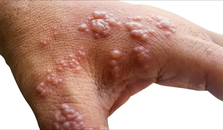 el-gobierno-informo-que-ya-son-51-los-infectados-viruela-del-mono-foto-the-health-site